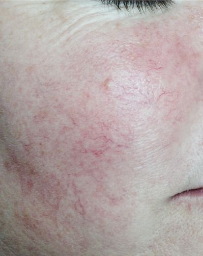 5 dấu hiệu nhận biết da nhiễm corticoid