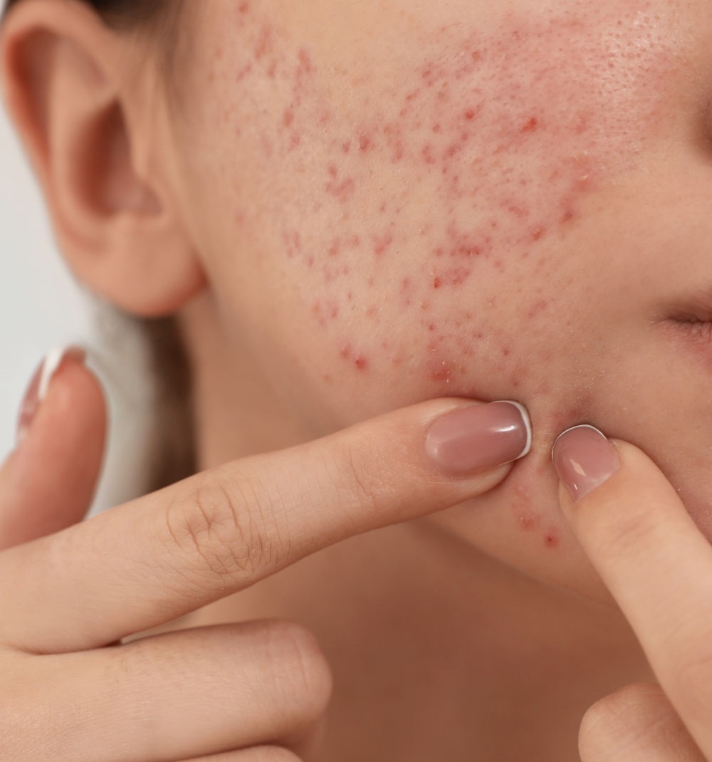 Nguyên nhân mụn nội tiết ở nữ và cách cải thiện